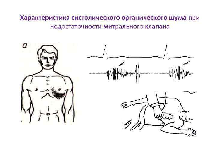Характеристика систолического органического шума при недостаточности митрального клапана 
