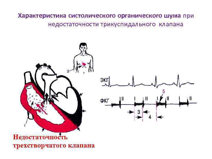 Недостаточность трехстворчатого клапана презентация