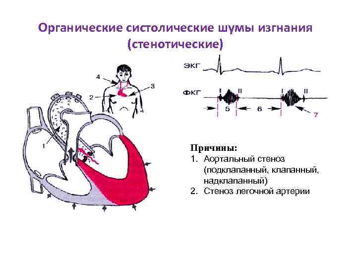 Аускультативная картина аортального стеноза