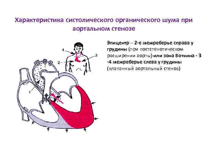 Характеристика систолического органического шума при аортальном стенозе • Эпицентр – 2 -е межреберье справа