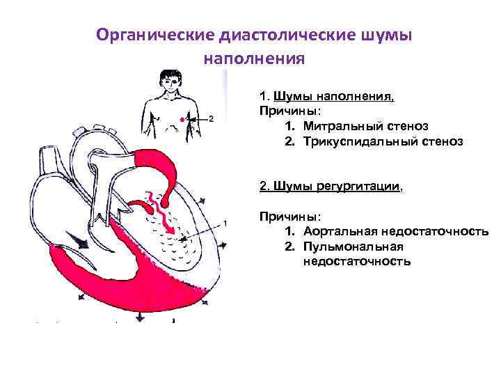 Трикуспидальная недостаточность презентация