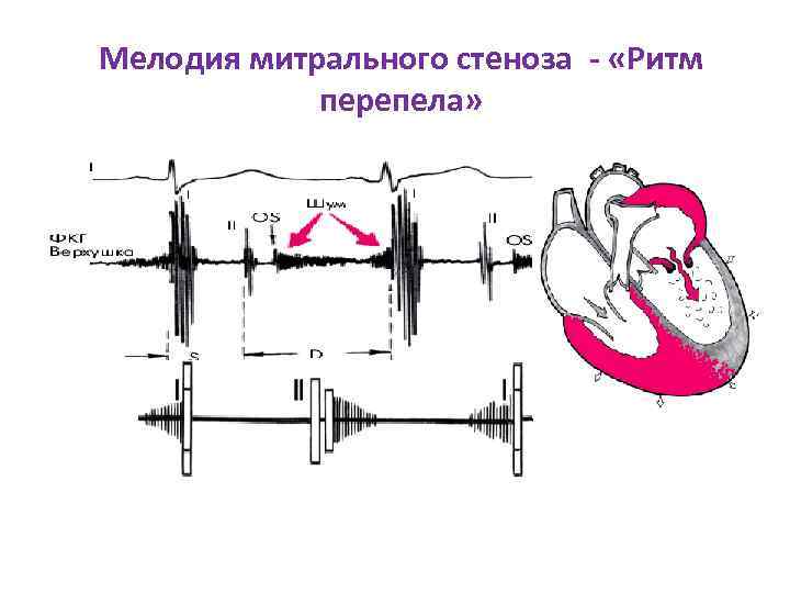 Мелодия митрального стеноза - «Ритм перепела» 