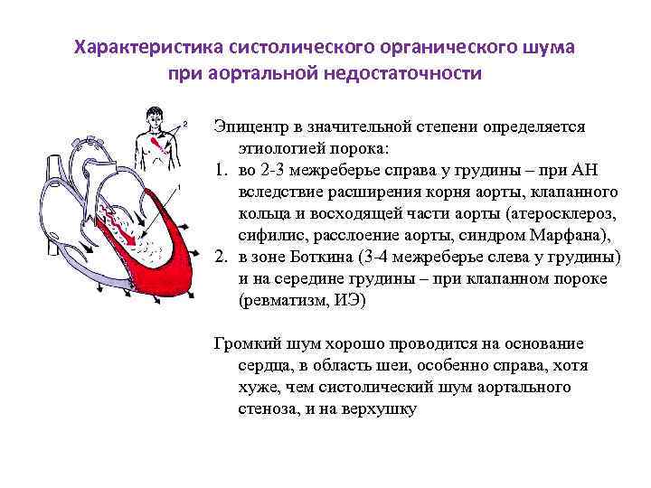Характеристика систолического органического шума при аортальной недостаточности Эпицентр в значительной степени определяется этиологией порока:
