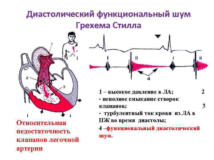 Диастолический шум на легочной артерии. Недостаточность клапана легочной артерии. Шум при недостаточности легочной артерии. Недостаточность клапана легочной артерии шум.