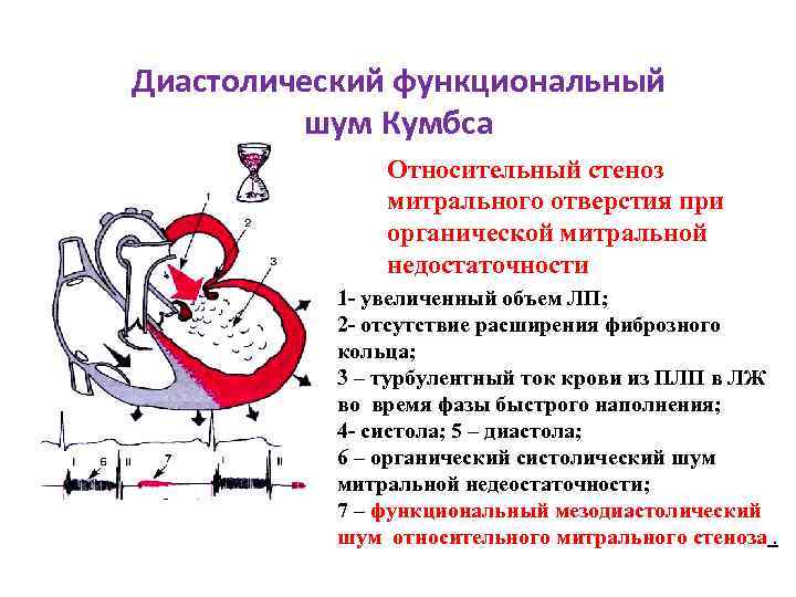 Стеноз митрального клапана аускультация