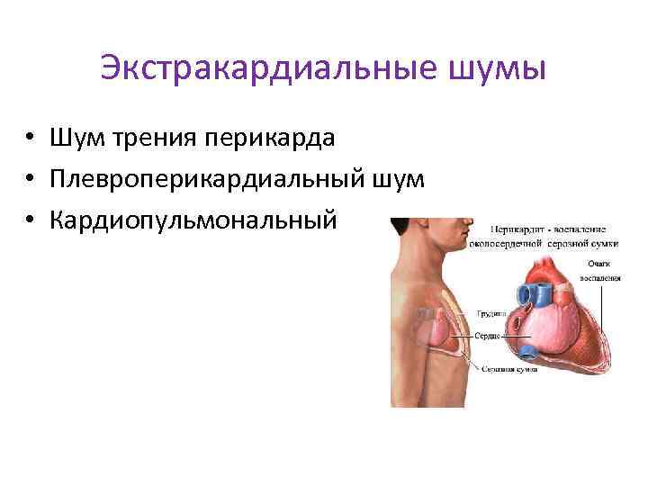 Экстракардиальные шумы • Шум трения перикарда • Плевроперикардиальный шум • Кардиопульмональный 