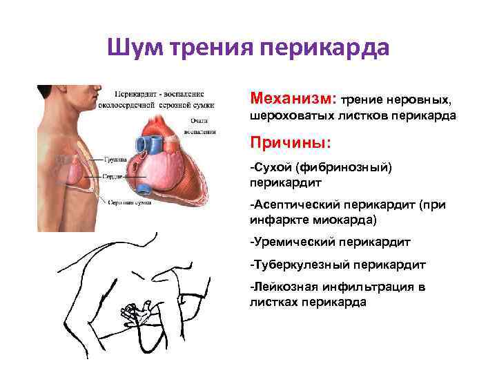 Шум трения перикарда Механизм: трение неровных, шероховатых листков перикарда Причины: -Сухой (фибринозный) перикардит -Асептический