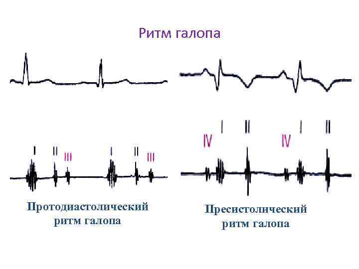 Ритм галопа Протодиастолический ритм галопа Пресистолический ритм галопа 