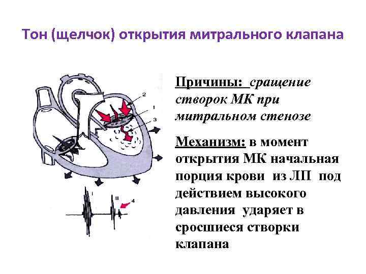 Тон (щелчок) открытия митрального клапана Причины: сращение створок МК при митральном стенозе Механизм: в