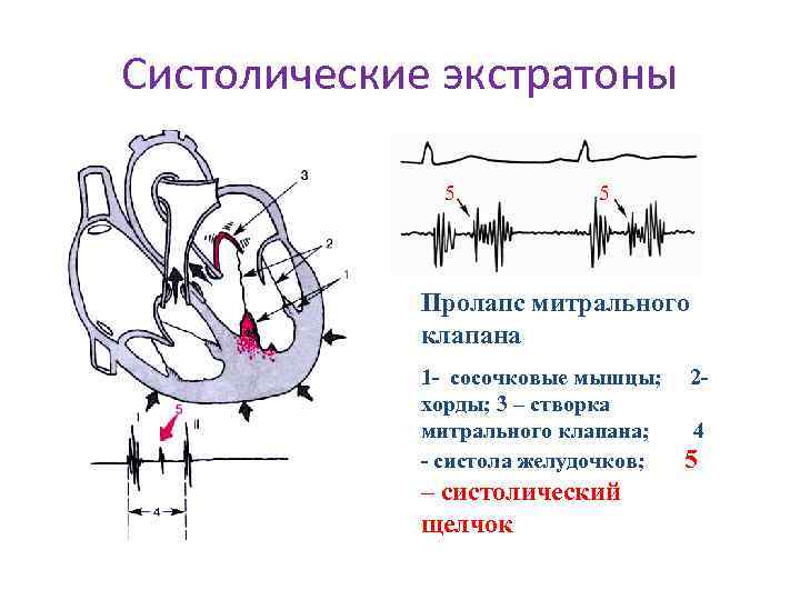 Систолические экстратоны 5 5 Пролапс митрального клапана 1 - сосочковые мышцы; хорды; 3 –