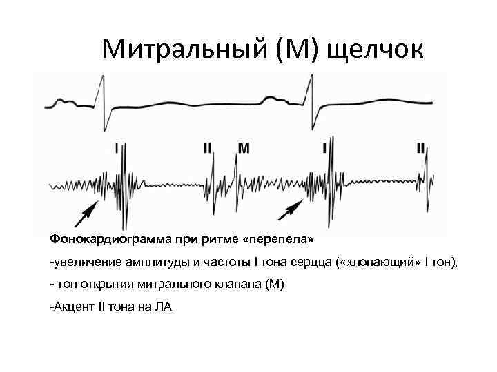 Митральный (М) щелчок Фонокардиограмма при ритме «перепела» -увеличение амплитуды и частоты I тона сердца