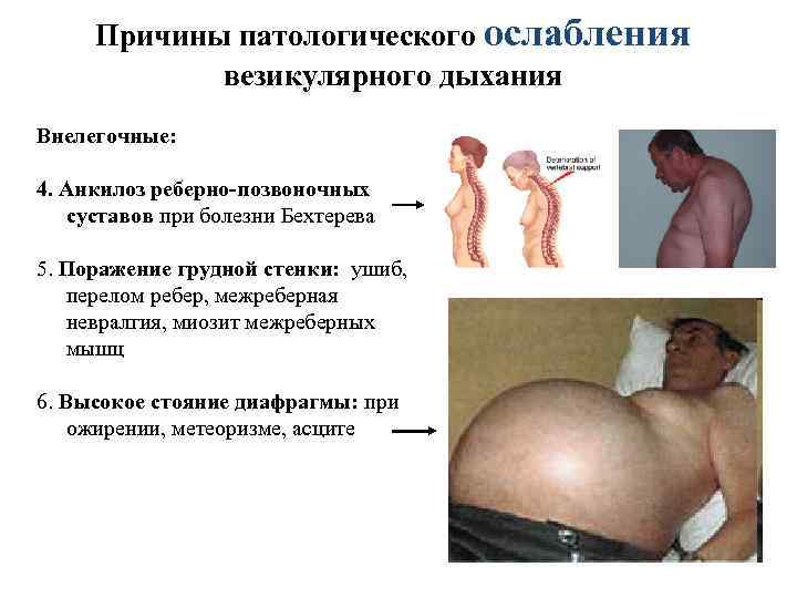 Причины патологического ослабления везикулярного дыхания Внелегочные: 4. Анкилоз реберно-позвоночных суставов при болезни Бехтерева 5.