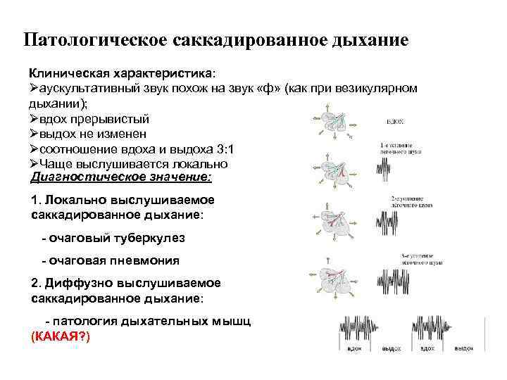 Патологическое саккадированное дыхание Клиническая характеристика: Øаускультативный звук похож на звук «ф» (как при везикулярном
