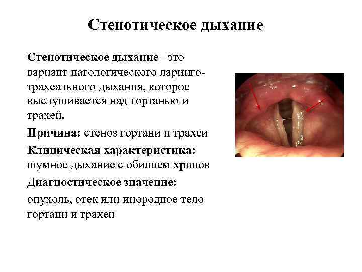 Стенотическое дыхание– это вариант патологического ларинготрахеального дыхания, которое выслушивается над гортанью и трахей. Причина: