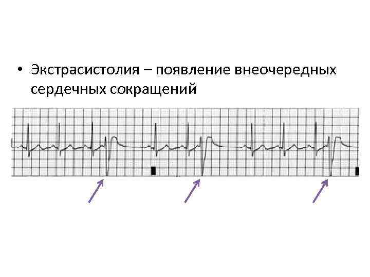  • Экстрасистолия – появление внеочередных сердечных сокращений 