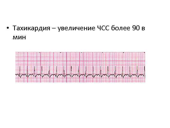  • Тахикардия – увеличение ЧСС более 90 в мин 