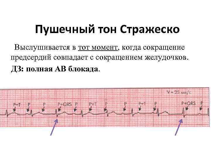 Пушечный тон Стражеско Выслушивается в тот момент, когда сокращение предсердий совпадает с сокращением желудочков.