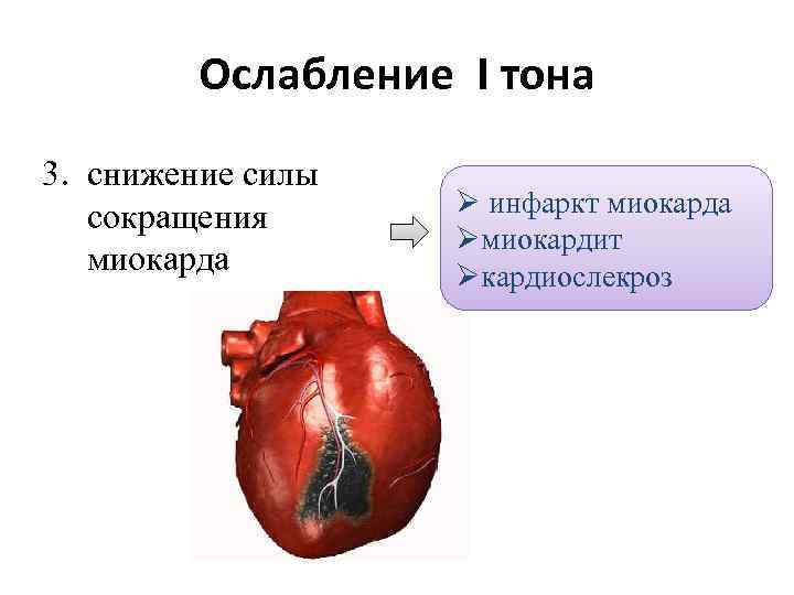 Ослабление I тона 3. снижение силы сокращения миокарда Ø инфаркт миокарда Øмиокардит Øкардиослекроз 