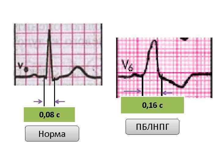 0, 08 с Норма 0, 16 с ПБЛНПГ 