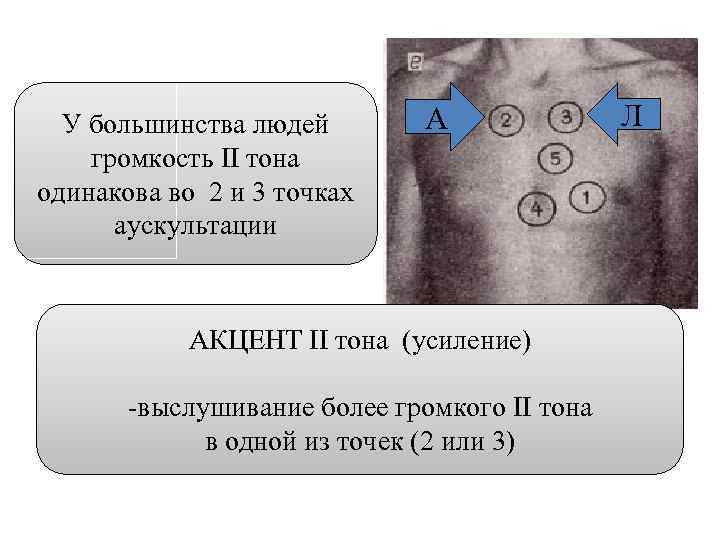 У большинства людей громкость II тона одинакова во 2 и 3 точках аускультации А