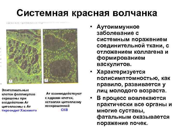 Системная красная волчанка Эпителиальные клетки фолликулов окрашены при воздействии Аг цитоплазмы с Ат тиреоидит