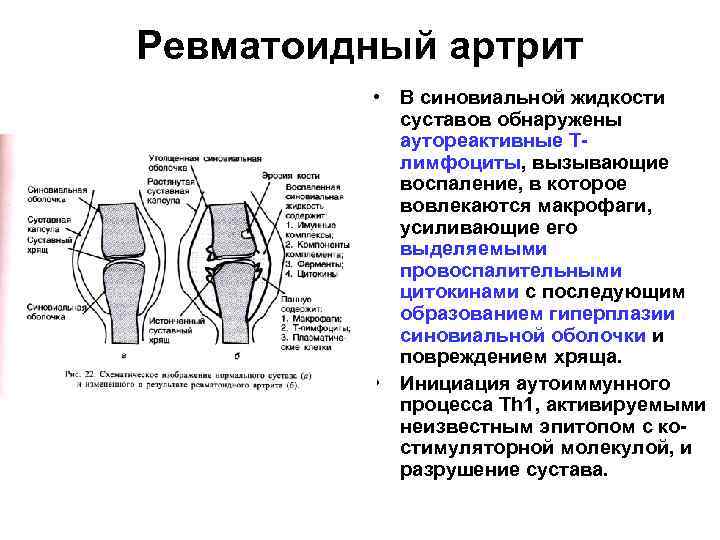 Ревматоидный артрит • В синовиальной жидкости суставов обнаружены аутореактивные Тлимфоциты, вызывающие воспаление, в которое