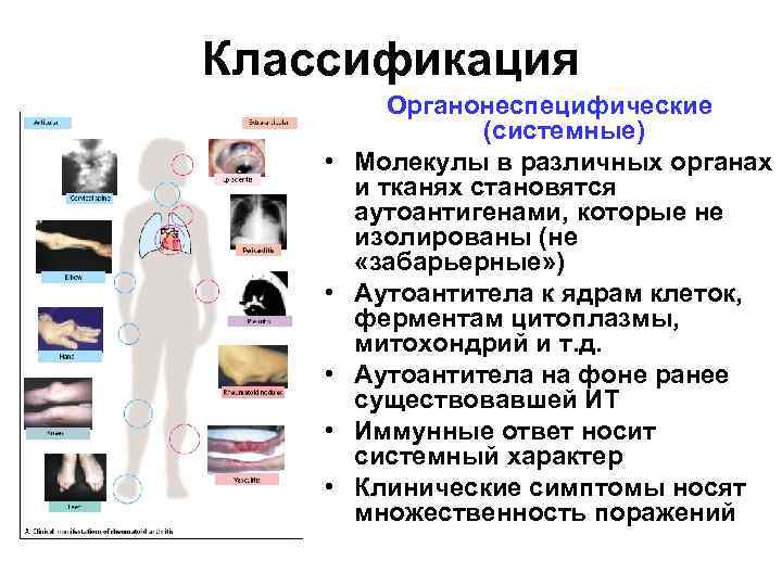 Классификация • • • Органонеспецифические (системные) Молекулы в различных органах и тканях становятся аутоантигенами,