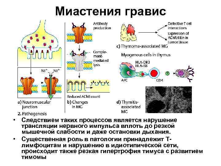 Схема аутоиммунной реакции