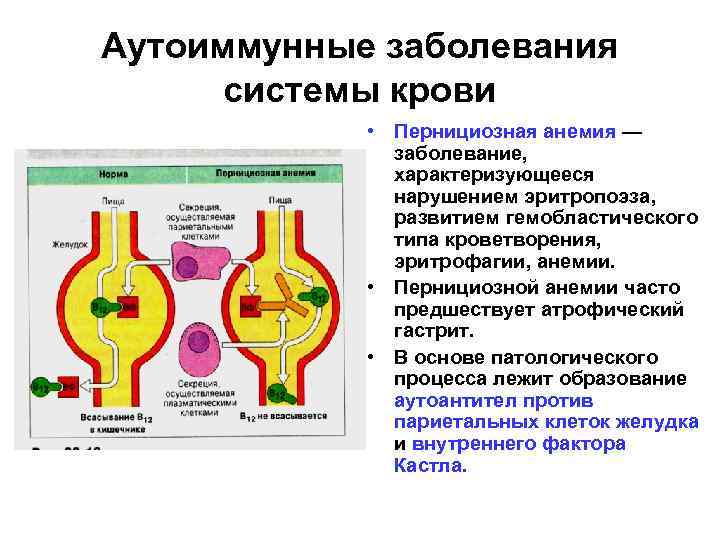 Аутоиммунная пернициозная анемия