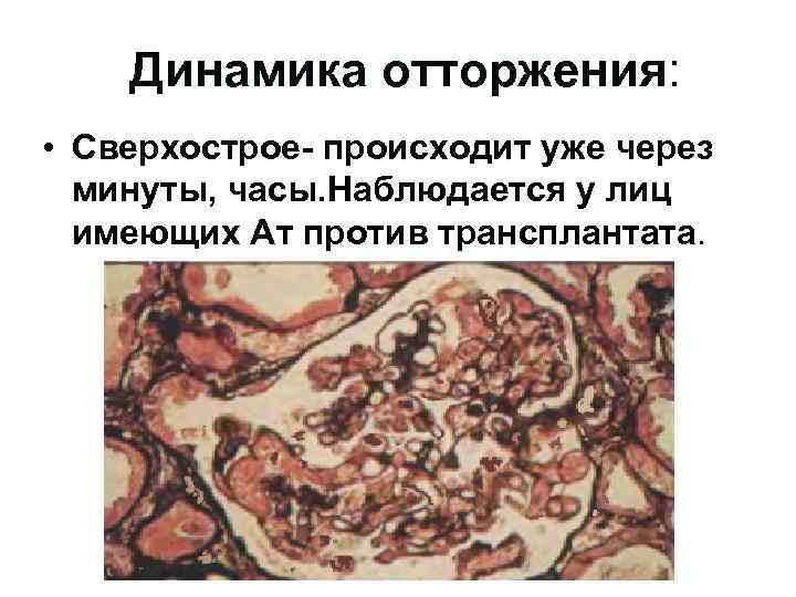Динамика отторжения: • Сверхострое- происходит уже через минуты, часы. Наблюдается у лиц имеющих Ат