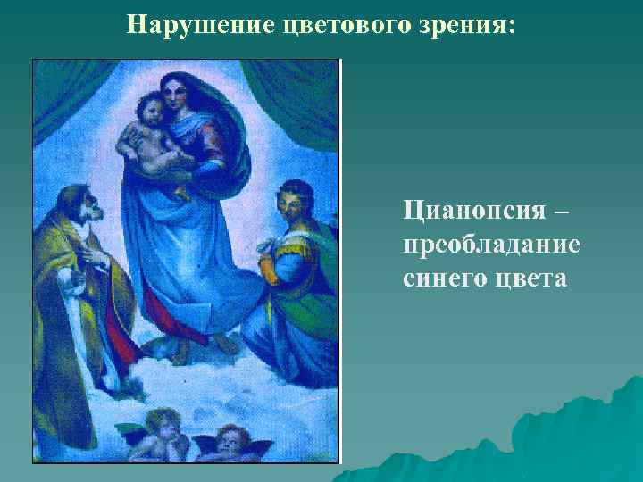 Нарушение цветового зрения: Цианопсия – преобладание синего цвета 