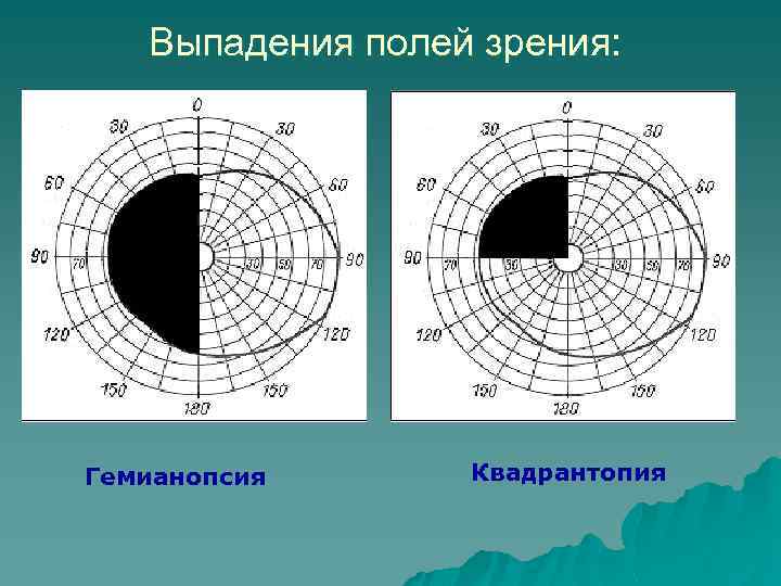 Схема полей зрения в норме рисунок