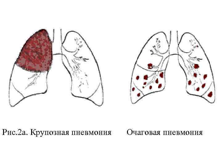 Крупозная пневмония картинки