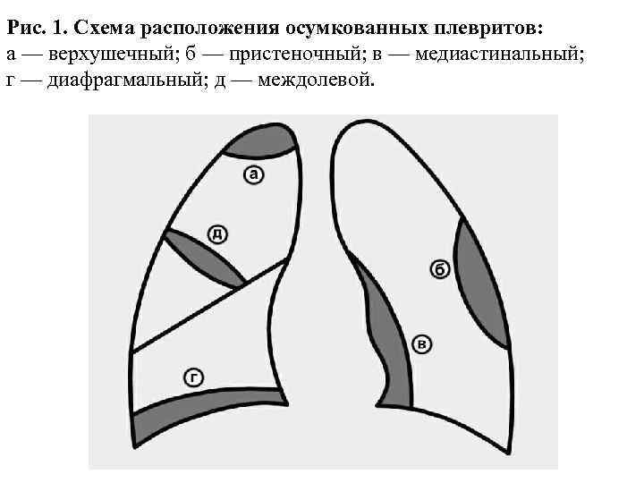 Рис. 1. Схема расположения осумкованных плевритов: а — верхушечный; б — пристеночный; в —