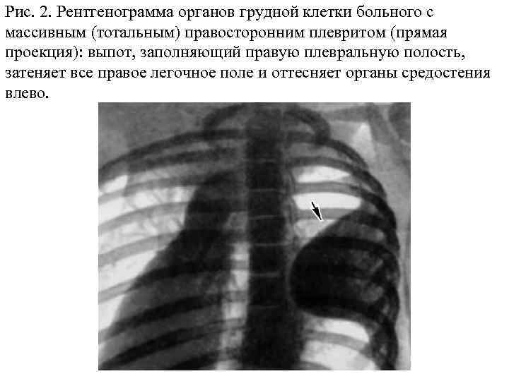 Рис. 2. Рентгенограмма органов грудной клетки больного с массивным (тотальным) правосторонним плевритом (прямая проекция):