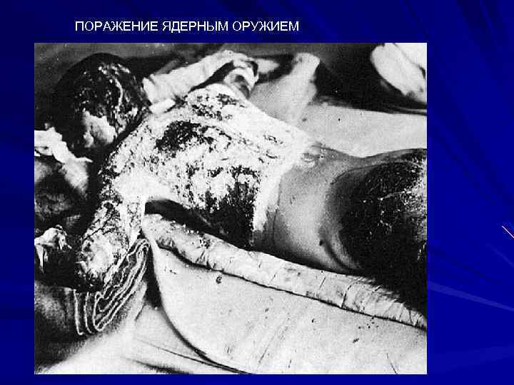 ПОРАЖЕНИЕ ЯДЕРНЫМ ОРУЖИЕМ 