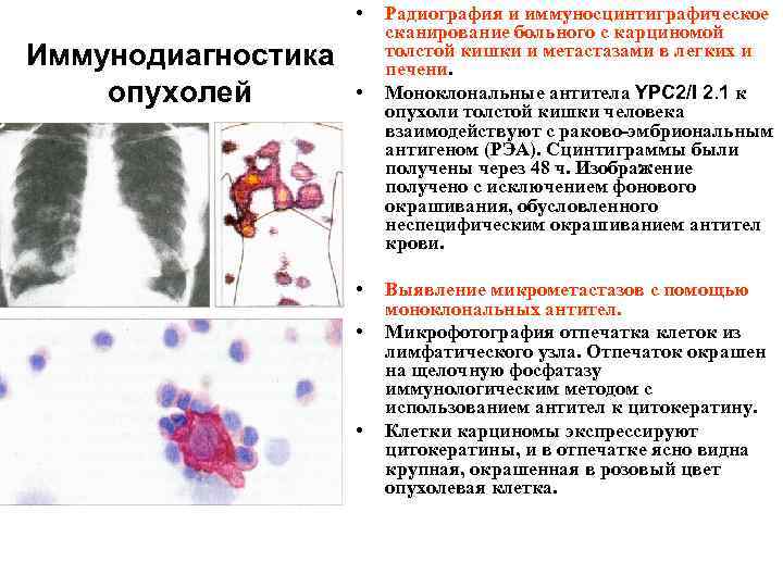  • Иммунодиагностика опухолей • • Радиография и иммуносцинтиграфическое сканирование больного с карциномой толстой
