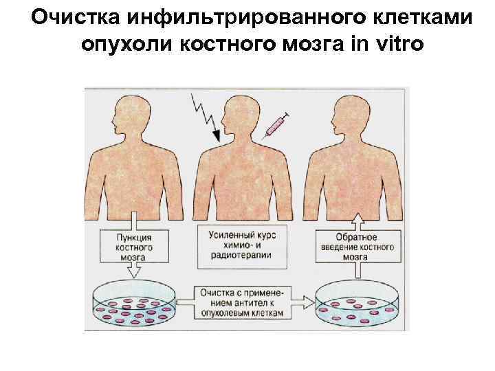 Очистка инфильтрированного клетками опухоли костного мозга in vitro 