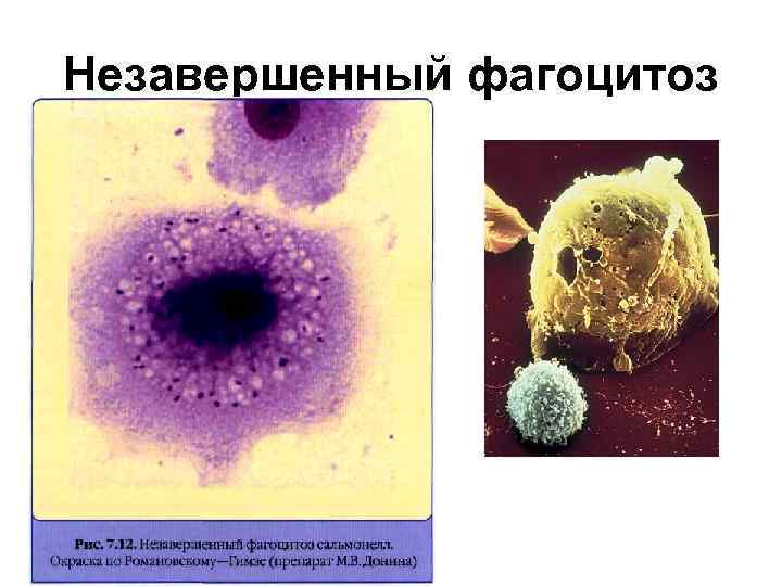 Незавершенный фагоцитоз 