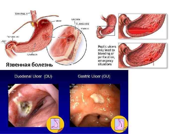 Язвенная болезнь желудка Язвенная болезнь 