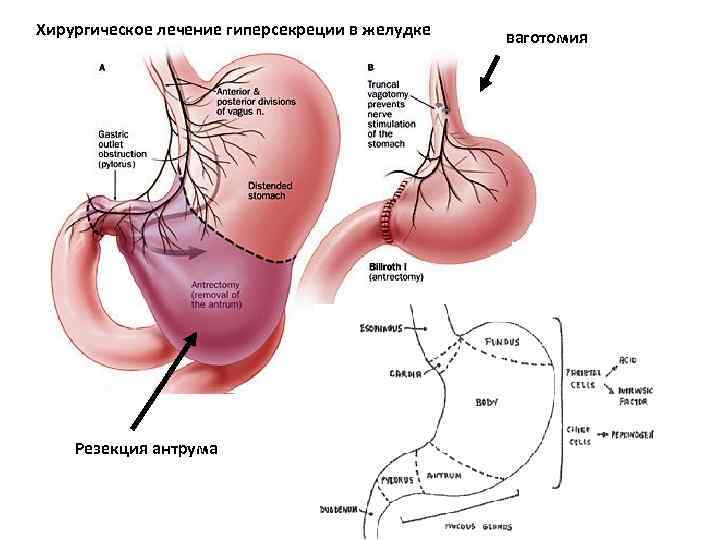 Хирургическое лечение гиперсекреции в желудке Резекция антрума ваготомия 