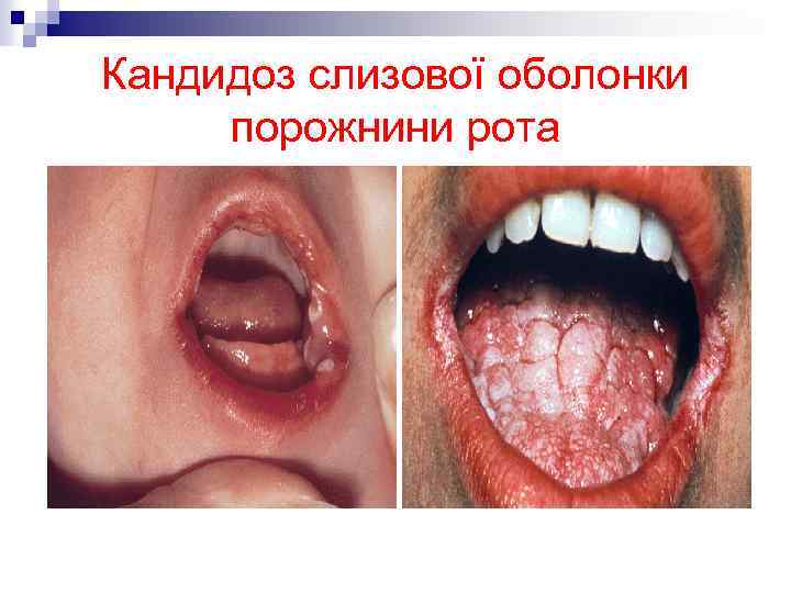 Кандидоз слизової оболонки порожнини рота 