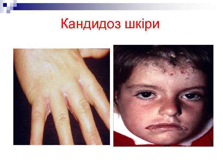 Кандидоз шкіри 