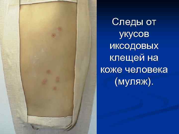 Следы от укусов иксодовых клещей на коже человека (муляж). 