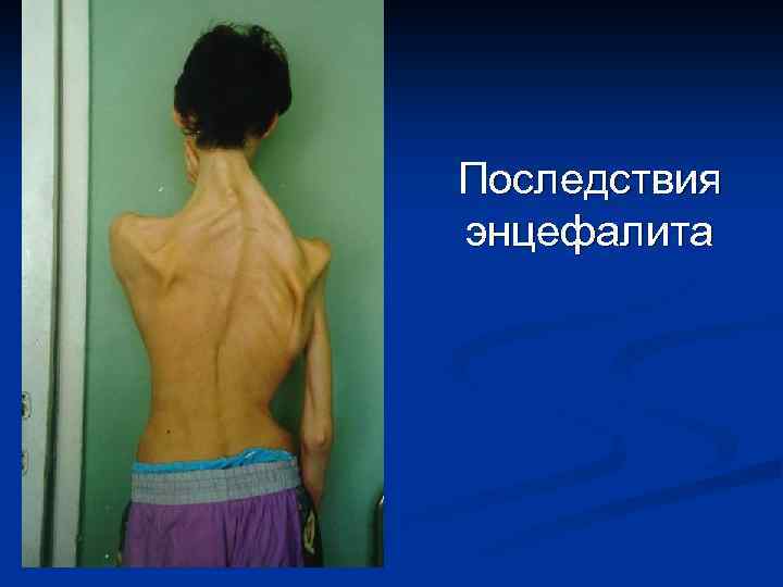 Последствия энцефалита 