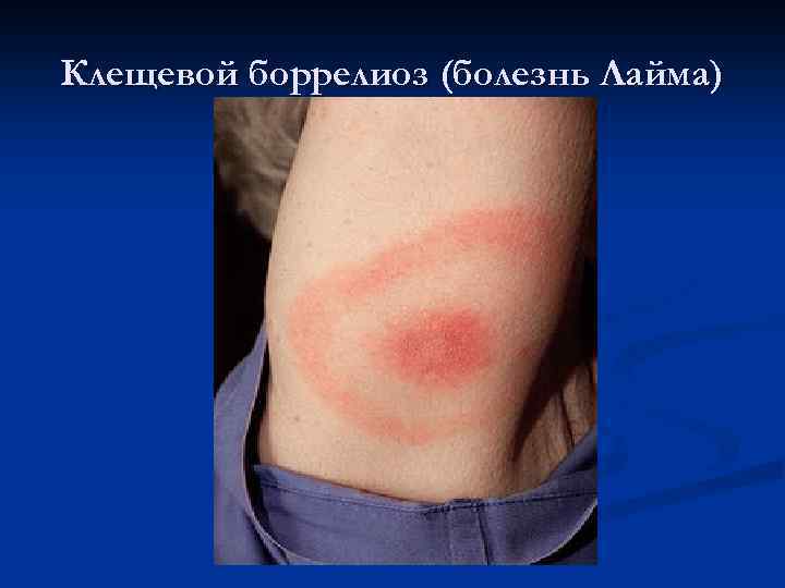 Клещевой боррелиоз (болезнь Лайма) 
