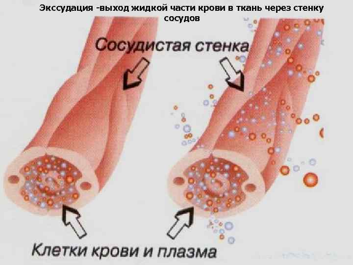 Экссудация -выход жидкой части крови в ткань через стенку сосудов 