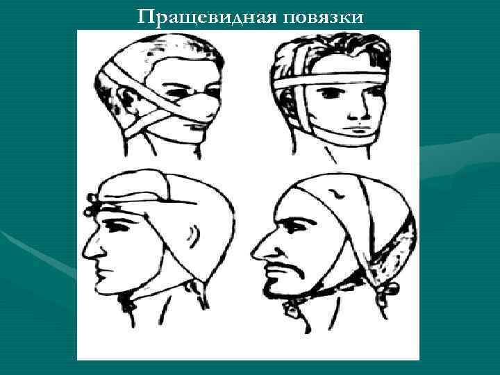 Пращевидная повязка. Пращевидная повязка на голову. Пращевидная повязка на затылок. Наложение пращевидной повязки на голову. Десмургия пращевидная повязка.