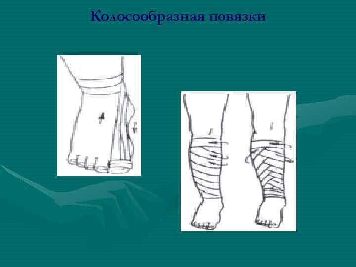 Колосообразная повязки 