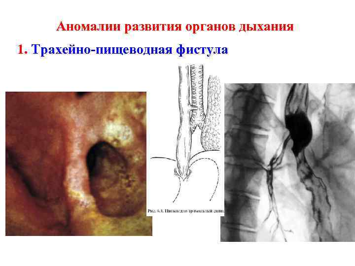 Аномалии развития органов дыхания 1. Трахейно-пищеводная фистула 